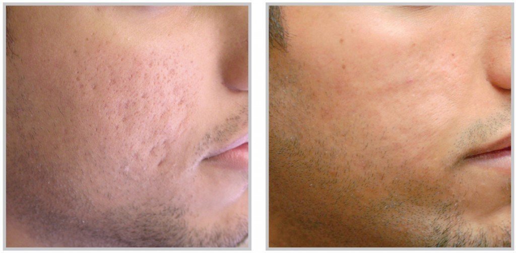 Before and after cheek acne scar treatment showing smoother skin texture