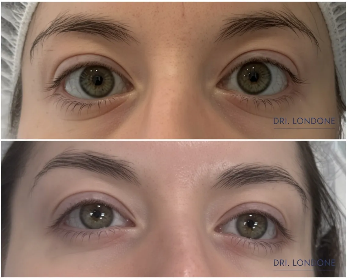 pdrn-polynucleotide-under-eye-treatment.webp