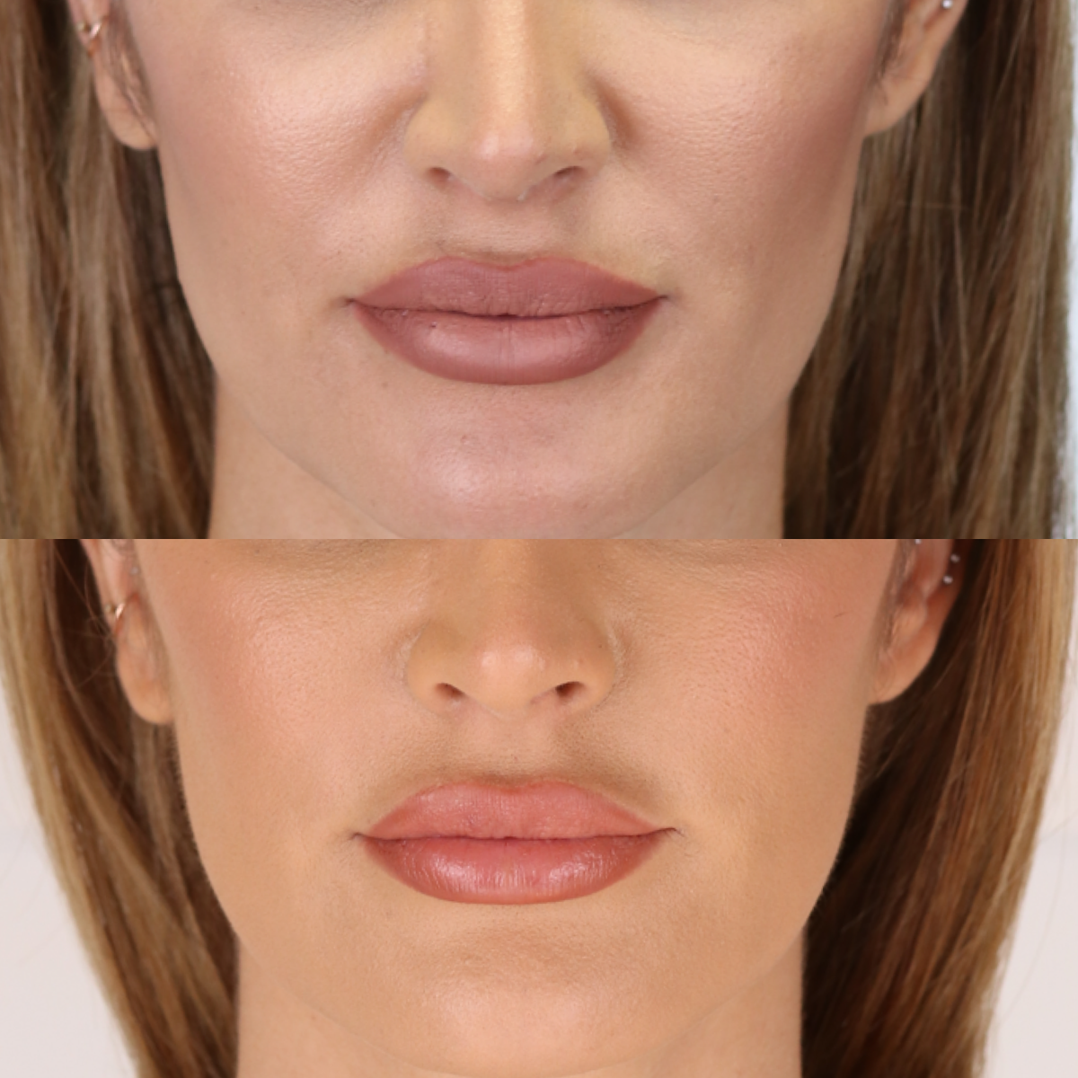 Tractament de les l&iacute;nies del somriure | Farciment de plecs nasolabials | JUV&Eacute;DERM&reg; Dermal...