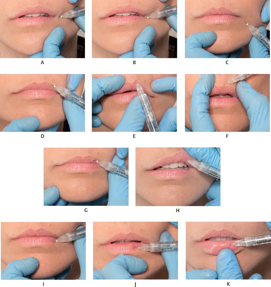 marionette-injection-steps.jpg