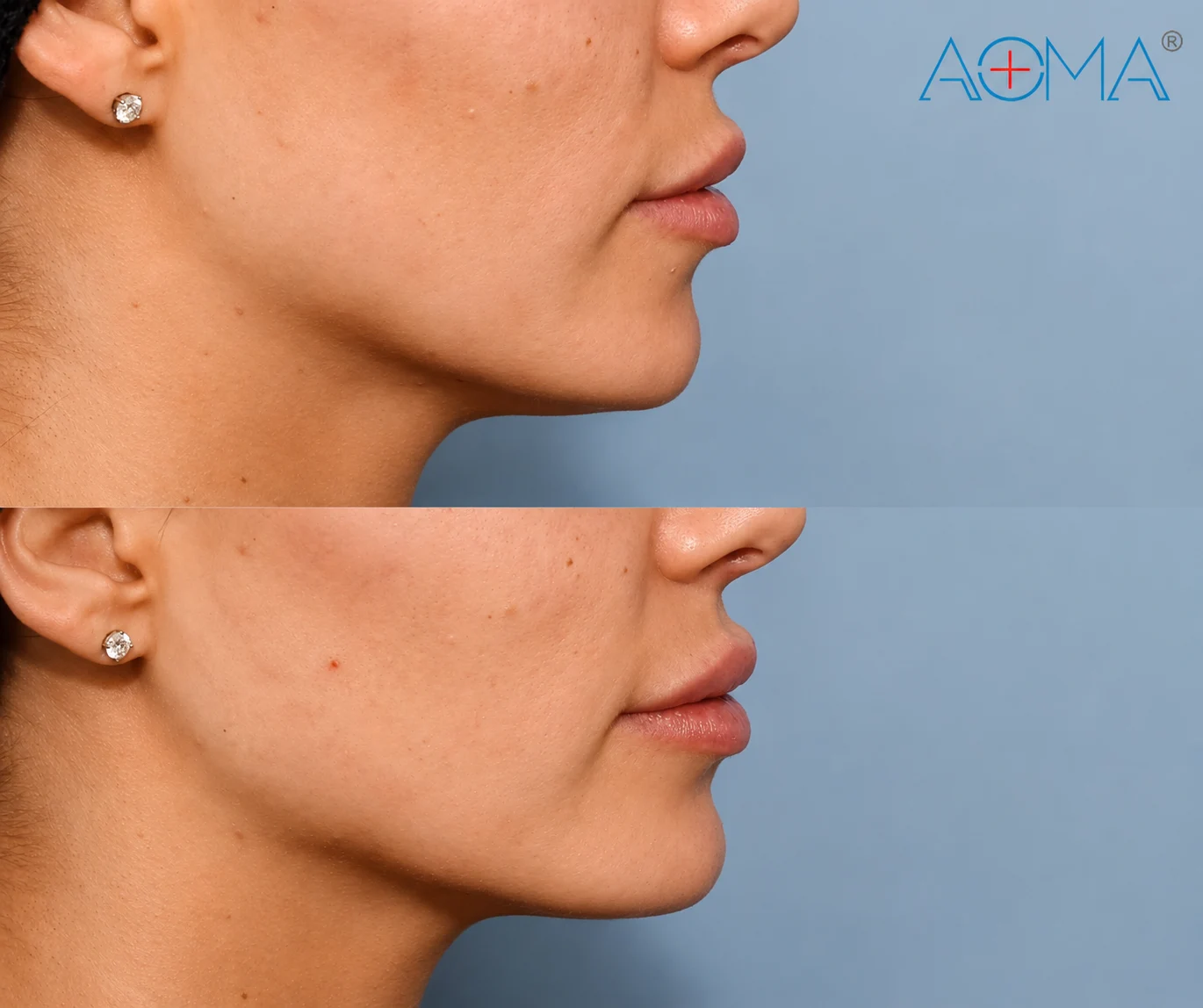 lip-filler-before-after-results-aoma.webp