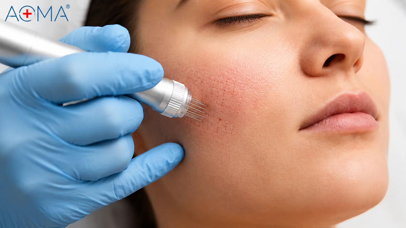 skin-booster-vs-mesotherapy-microneedling-aoma.webp